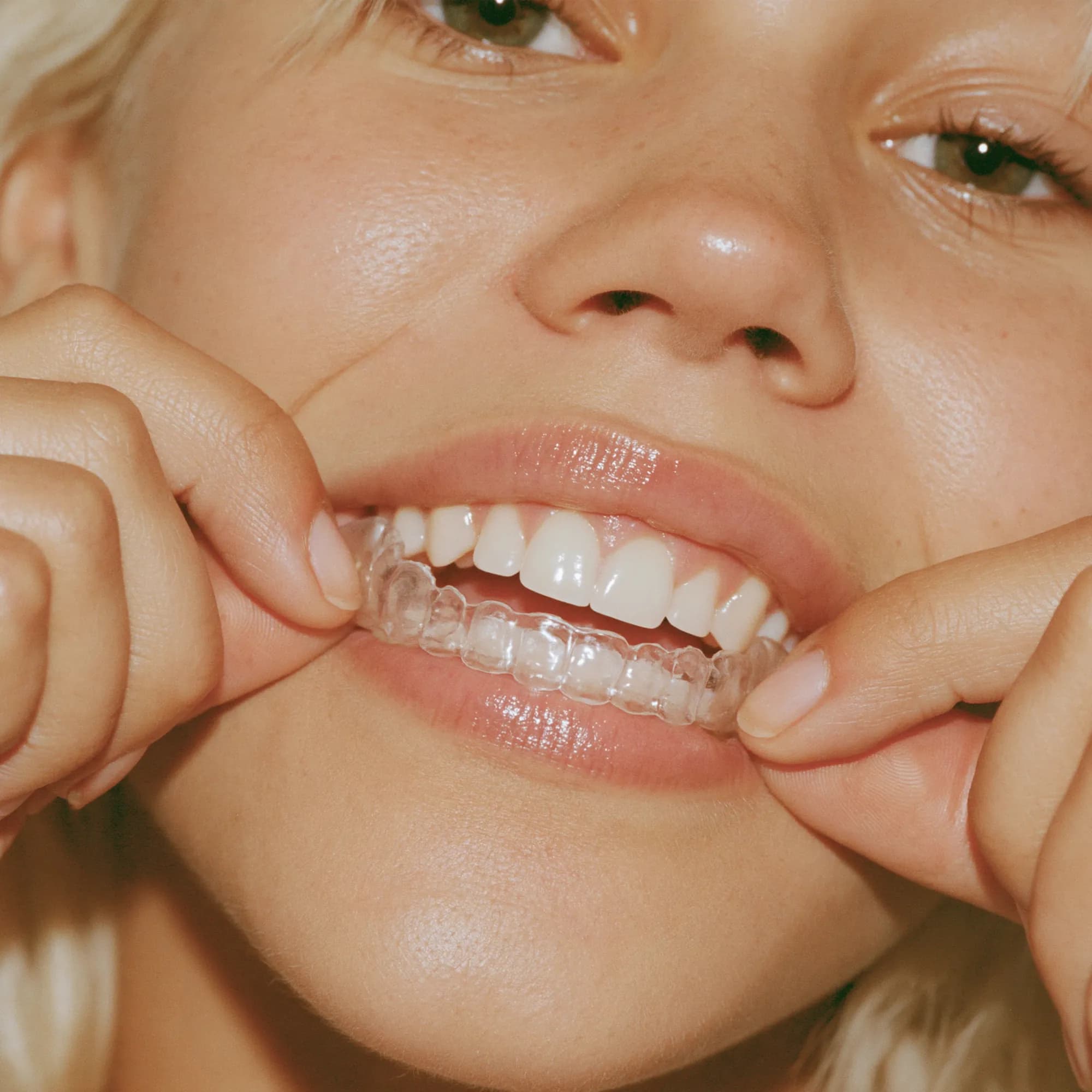 A person placing a clear aligner, mid-smile